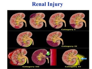 Renal Injury
.
Classification of Injury
• Grade I : Contusion or Subcapsular
Hematoma
• Grade II: Non Expanding Hematoma, <1
cm deep ,no extravasation
• Grade III: Laceration >1cm with urinary
Extravasation
• Grade IV: Parenchymal Laceration
• Grade V: Renovascular injury
 