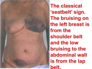The classical
‘seatbelt’ sign.
The bruising on
the left breast is
from the
shoulder belt
and the low
bruising to the
abdominal wall
is from the lap
belt.
 