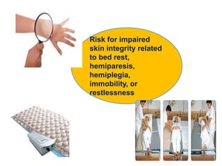 Risk for impaired
skin integrity related
to bed rest,
hemiparesis,
hemiplegia,
immobility, or
restlessness
 