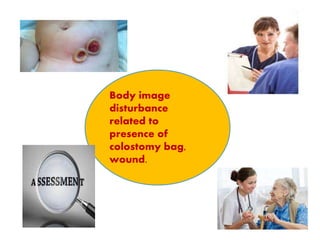 Body image
disturbance
related to
presence of
colostomy bag,
wound.
 
