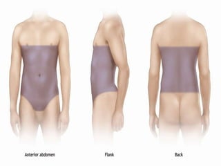 • Anterior abdomen:
Trans-nipple line, Anterior axillary lines,
Inguinal ligaments and Symphysis pubis.
• Flank:
Anterior and posterior axillary line;
Sixth intercostal to iliac crest.
• Back:
Posterior axillary line; Tip of scapula to
Iliac crest.
 