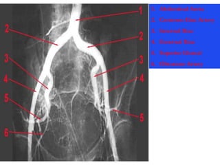 Vascular Anatomy
1. Abdominal Aorta
2. Common Iliac Artery
3. Internal Iliac
4. External Iliac
5. Superior Gluteal
6. Obturator Artery
 