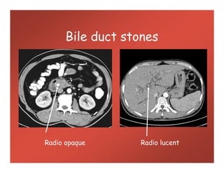 Bile duct stones
Radio opaque Radio lucent
 