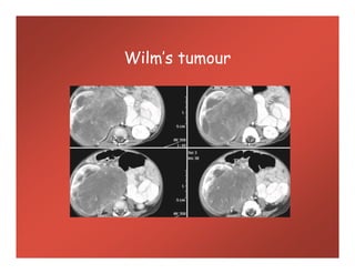 Wilm’s tumour
 