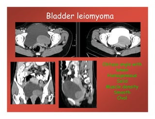 Bladder leiomyoma
Obtuse angle with
lumen
Homogeneous
Solid
Muscle density
Smooth
Oval
 