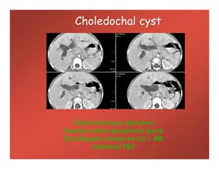 Choledochal cyst
Fusiform biliary dilatation
Normal calibre peripheral ducts
Intrahepatic stones on US / MR
Abnormal PBJ
 