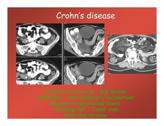 Crohn’s disease
Gradation of severity – skip lesions
Asymmetry – anti-mesenteric sacculations
Mesenteric longitudinal ulcers
“Creeping fat” – “Comb” sign
Inter loop fistulae
 