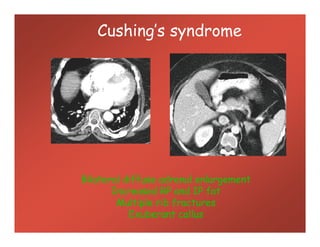Cushing’s syndrome
Bilateral diffuse adrenal enlargement
Increased RP and IP fat
Multiple rib fractures
Exuberant callus
 