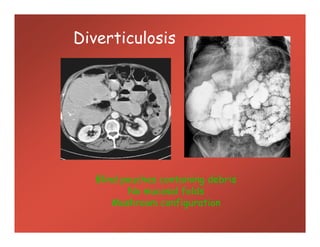 Diverticulosis
Blind pouches containing debris
No mucosal folds
Mushroom configuration
 