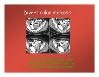 Diverticular abscess
“Saw tooth” sigmoid colon - LIF
Air and contrast within collection
Intramural tracking of contrast
 