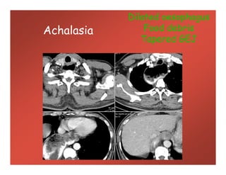 Achalasia
Dilated oesophagus
Food debris
Tapered GEJ
 