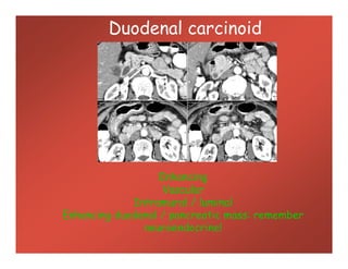 Duodenal carcinoid
Enhancing
Vascular
Intramural / luminal
Enhancing duodenal / pancreatic mass: remember
neuroendocrine!
 