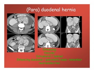 (Para) duodenal hernia
Enhancing
Vascular
Intramural / luminal
Enhancing duodenal / pancreatic mass: remember
neuroendocrine!
 