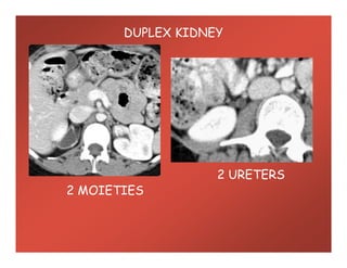 DUPLEX KIDNEY
2 URETERS
2 MOIETIES
 