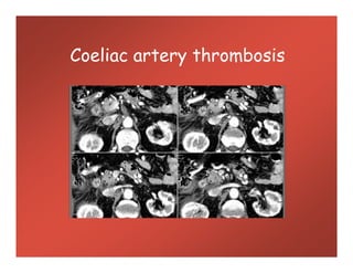 Coeliac artery thrombosis
 