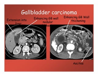 Gallbladder carcinoma
Enhancing GB Wall
thickeningExtension into
liver
Enhancing GB wall
nodular
thickening
Ascites
 