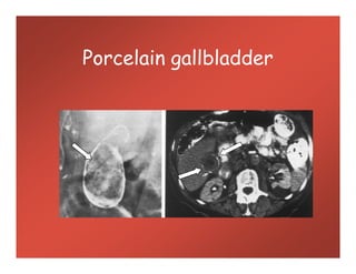 Porcelain gallbladder
 