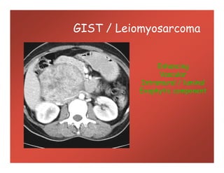 GIST / Leiomyosarcoma
Enhancing
Vascular
Intramural / luminal
Exophytic component
Enhancing
Vascular
Intramural / luminal
Exophytic component
 