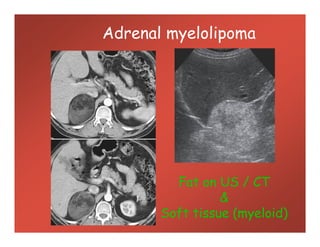 Adrenal myelolipoma
Fat on US / CT
&
Soft tissue (myeloid)
 