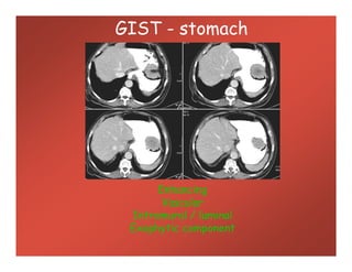 GIST - stomach
Enhancing
Vascular
Intramural / luminal
Exophytic component
 