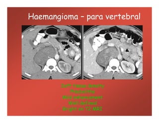Haemangioma – para vertebral
Soft tissue density
Phleboliths
Mild enhancement
Well defined
Bright on T2 MRI
 