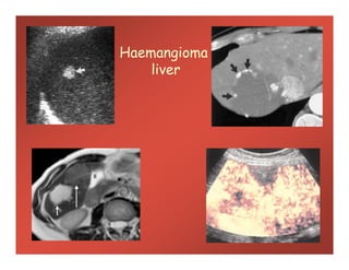 Haemangioma
liver
 