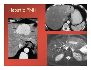 Hepatic FNH
 