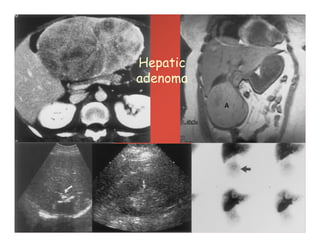 Hepatic
adenoma
 