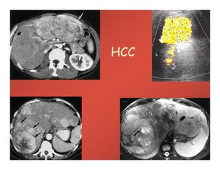 HCC
 