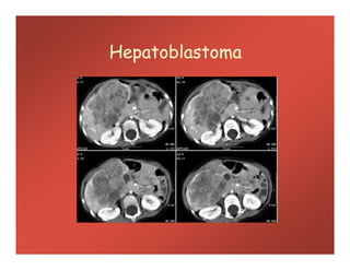 Hepatoblastoma
 