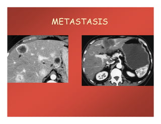 METASTASIS
 
