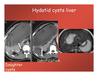Hydatid cysts liver
Daughter
cysts
calcification
 