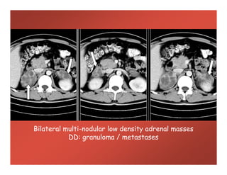 Bilateral multi-nodular low density adrenal masses
DD: granuloma / metastases
 