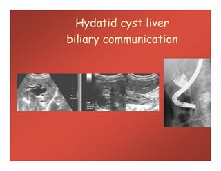 Hydatid cyst liver
biliary communication
 