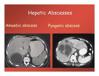Amoebic abscess Pyogenic abscess
Hepatic Abscesses
 