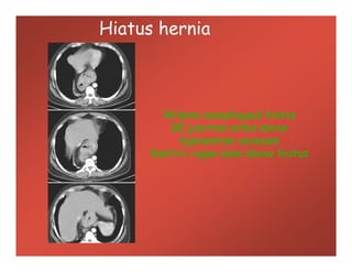 Hiatus hernia
Widens oesophageal hiatus
GE junction sited above
ligamentum venosum
Gastric rugae seen above hiatus
Widens oesophageal hiatus
GE junction sited above
ligamentum venosum
Gastric rugae seen above hiatus
 