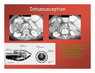 Intussusception
Crescent of mesenteric fat
Lead point 75% adults
Coiled spring
Target / Bull’s eye
Hayfork / trident
 