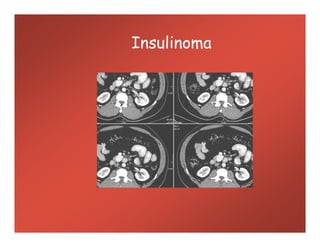 Insulinoma
 