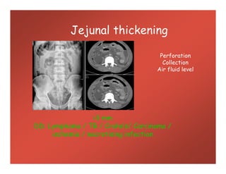 Jejunal thickening
Perforation
Collection
Air fluid level
>3 mm
DD: Lymphoma / TB / Crohn’s/ Carcinoma /
ischemia / necrotising infection
 