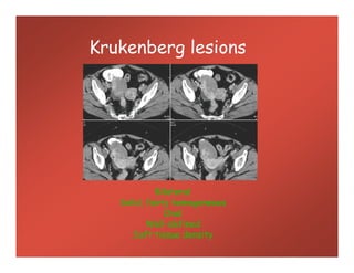 Krukenberg lesions
Bilateral
Solid, fairly homogeneous
Oval
Well-defined
Soft tissue density
 
