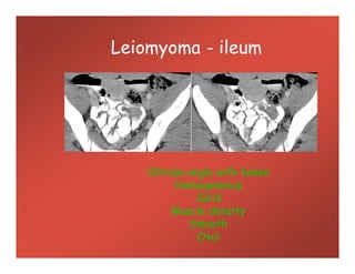 Leiomyoma - ileum
Obtuse angle with lumen
Homogeneous
Solid
Muscle density
Smooth
Oval
 