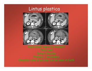 Lintus plastica
Rigid small capacity stomach
Thick wall
Intact mucosa
Primary / secondary
Omental cake & ascites can be seen in both
 