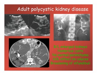 Adult polycystic kidney disease
B/L enlarged kidneys
Numerous cysts
No normal parenchyma
SOL effect on calyces
Broadening of infundibuli
 