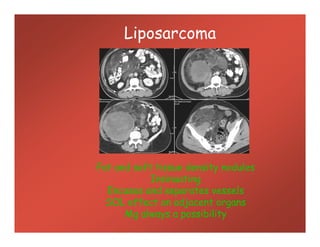 Liposarcoma
Fat and soft tissue density nodules
Insinuating
Encases and separates vessels
SOL effect on adjacent organs
Mg always a possibility
 