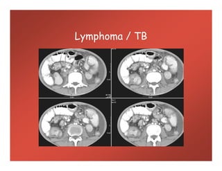 Lymphoma / TB
 