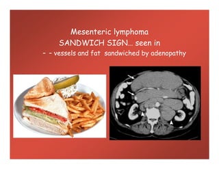 Mesenteric lymphoma
SANDWICH SIGN… seen in
– – vessels and fat sandwiched by adenopathy
 