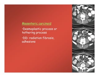 Mesenteric carcinoidMesenteric carcinoid
•Desmoplastic process or
tethering process
•DD: radiation fibrosis,
adhesions
Mesenteric carcinoidMesenteric carcinoid
•Desmoplastic process or
tethering process
•DD: radiation fibrosis,
adhesions
 
