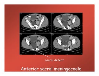 Anterior sacral meningocoele
sacral defect
mass
 