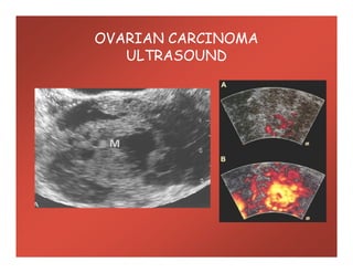 OVARIAN CARCINOMA
ULTRASOUND
 