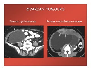 Serous cystadenoma Serous cystadenocarcinoma
OVARIAN TUMOURS
 